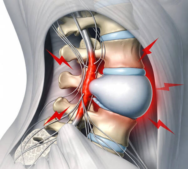 Грыжа диска L5-S1: когда можно обойтись без операции