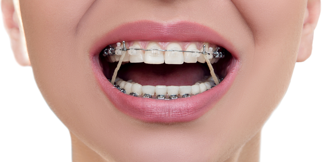 Зачем нужны эластики для брекетов?