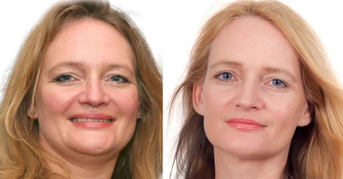 Слева- лицо женщины, с гипотериозом: отекшее, с нависшими веками, ожирением (тоже от метаболизма гормонов ЩЖ зависит), наметившийся зоб.