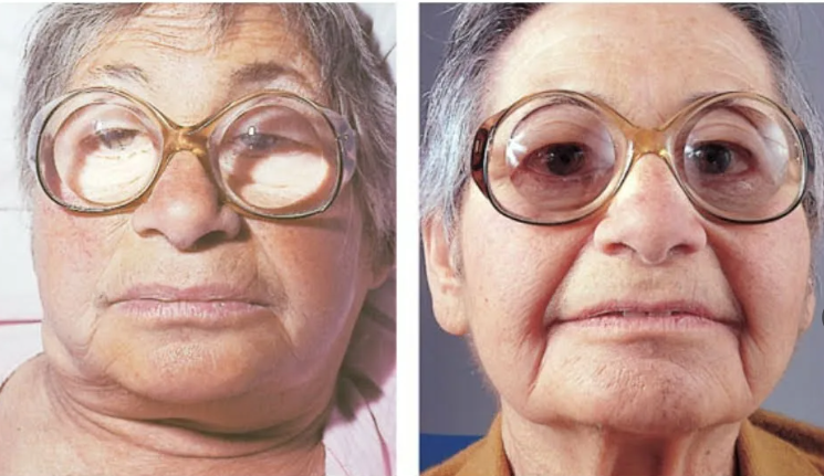 Женщина с гипотериозом слева - до лечения, справа - после.