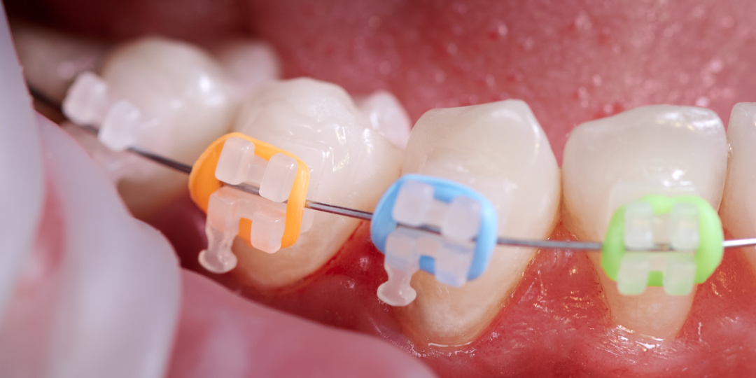 Как проходит лечение на брекетах по этапам и что важно знать