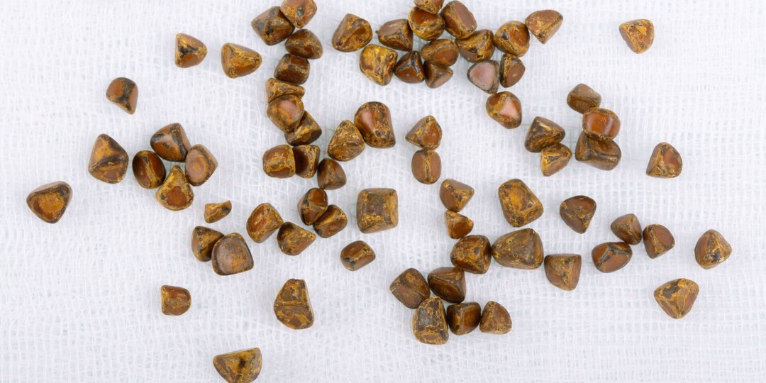 Как избежать образования камней в желчном