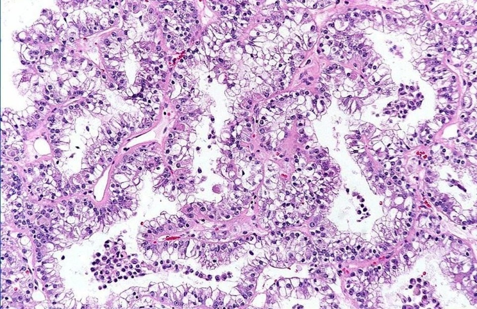    Транслокационная карцинома. Срез.https://pathology.jhu.edu/renal-cell-carcinoma/under-the-microscope