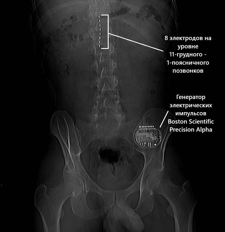 Электронейростимулятор Boston Scientific на рентгенограмме.