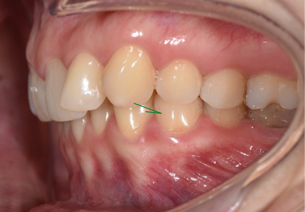 клык ушел сильно вперед, смыкаясь только с одним зубом на верхней челюсти.