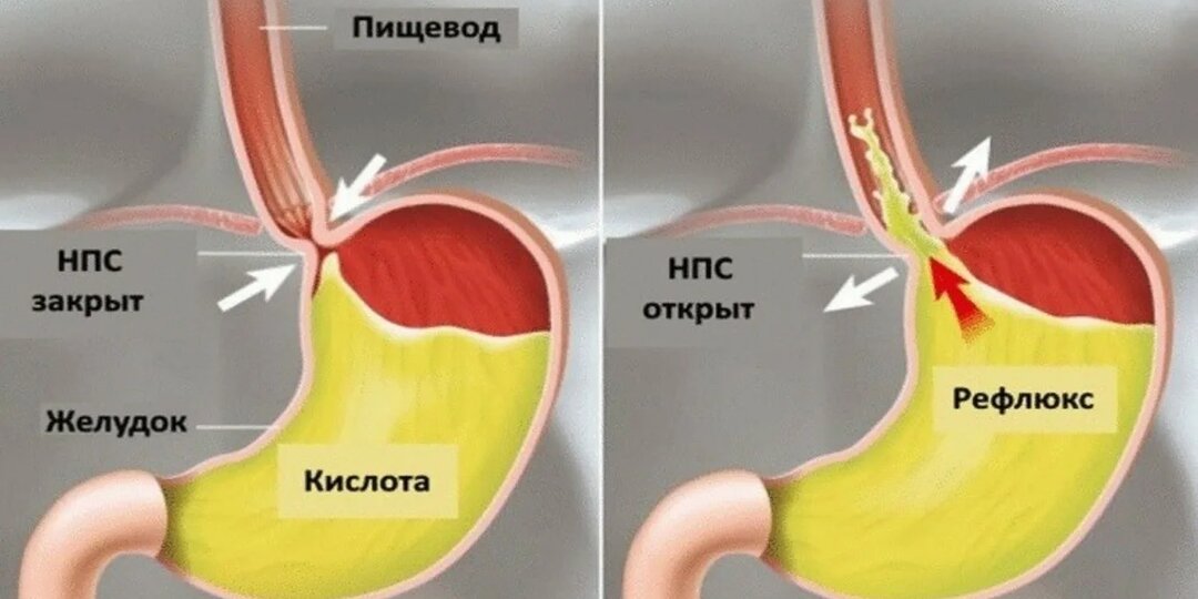 Жжение в груди после еды? Это не «просто изжога» — возможно это ГЭРБ. Что это такое и как жить без дискомфорта