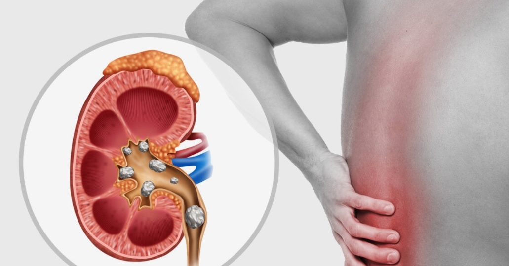 Камни в почках: как они появляются, почему болят — и что делать, чтобы не стать их заложником
