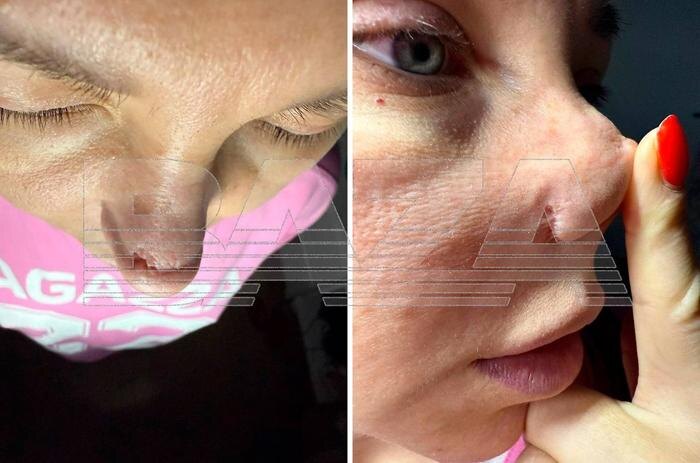 Последствия неудачной ринопластики. Фото © Baza