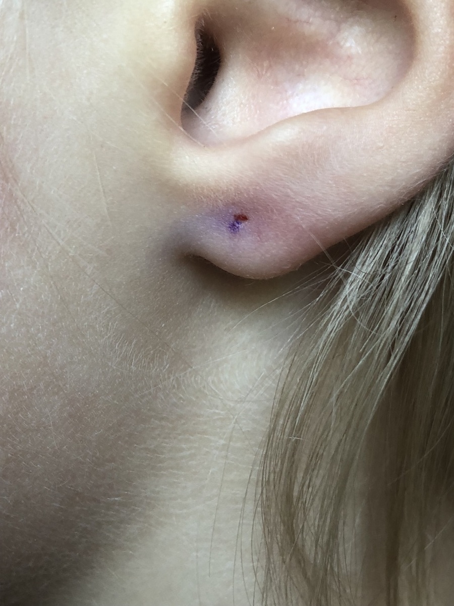 Прокол сместили не ближе к лицу, как нужно было, а дальше от лица, что усугубило изначальную разницу.