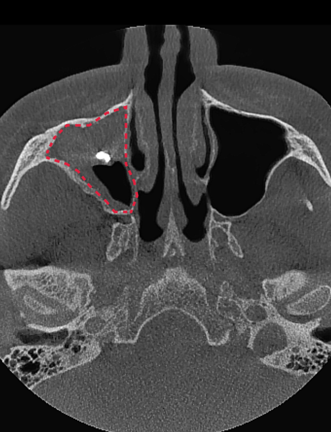 Подготовка к синус-лифтингу. Компьютерная томография до ЛОР-лечения. На снимке видим инородное тело и грибковую ткань в пазухе. Синус-лифтинг проводить нельзя.
