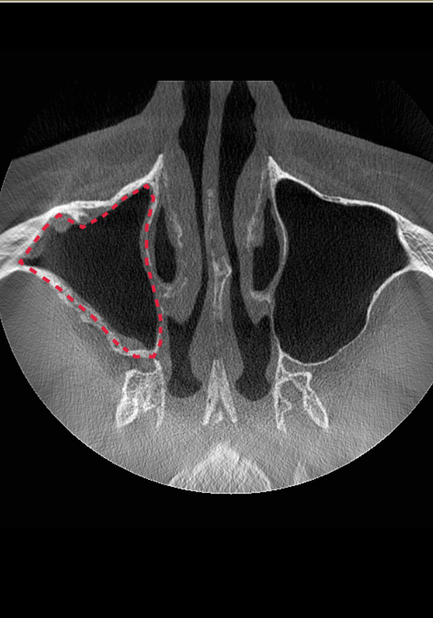 Компьютерная томография после ЛОР-лечения. Синус-лифтинг проводить можно.