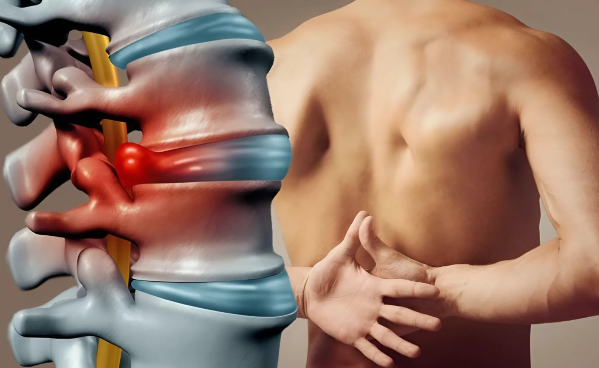 Грыжа позвоночника: как жить, двигаться и не бояться боли