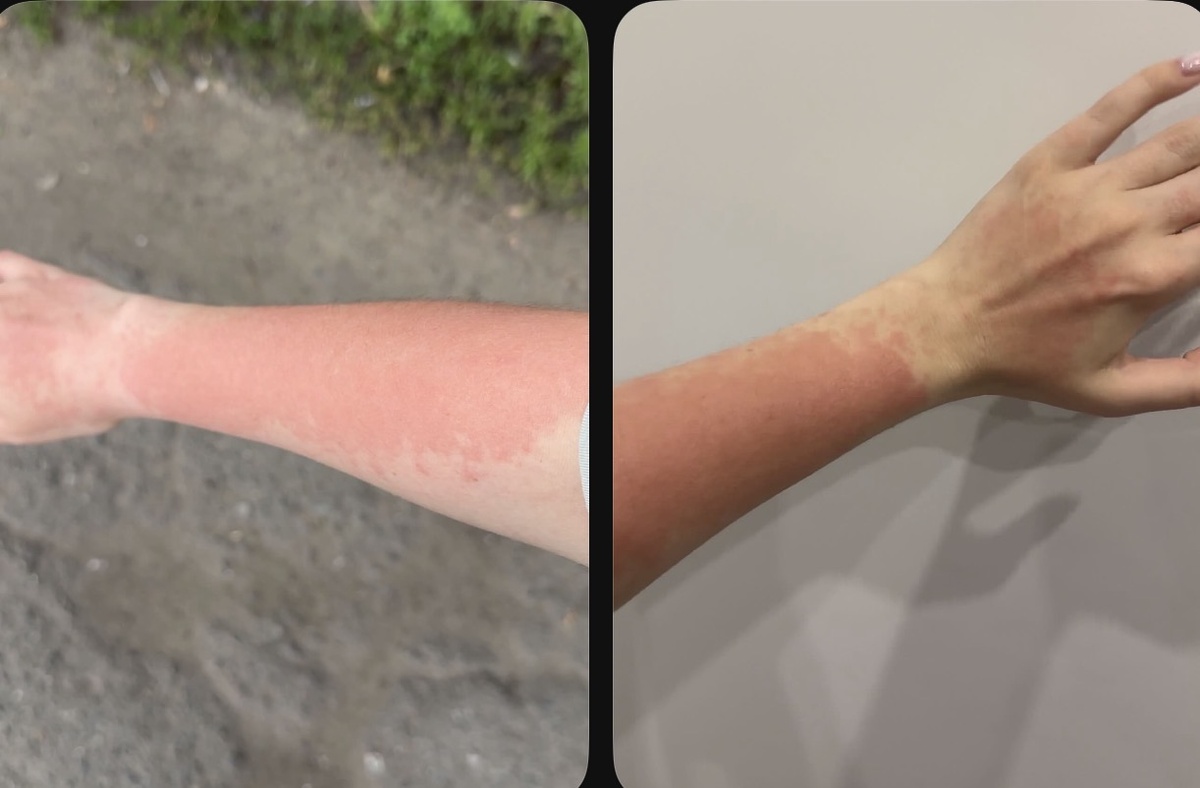 сильный кожный зуд