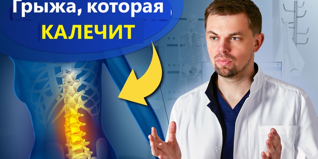 Грыжа межпозвонкового диска: правда, которую скрывают