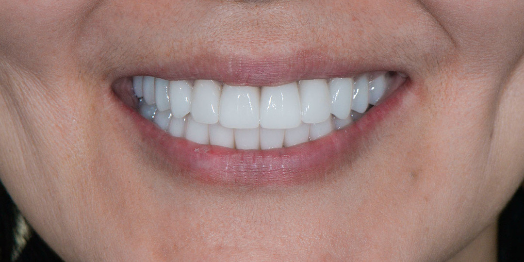 Тотальное протезирование керамикой с реконструкцией прикуса и восстановлением отсутствующих зубов с помощью имплантации