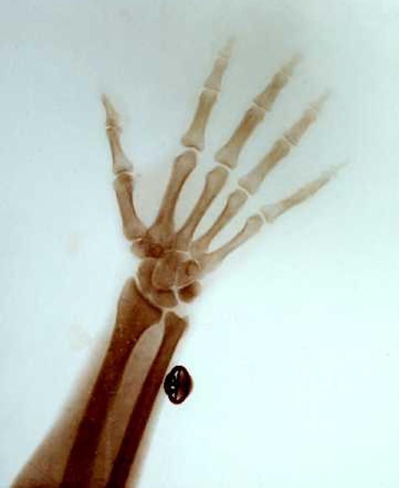 Рентген правой руки императора Николая II с запонкой (1898)