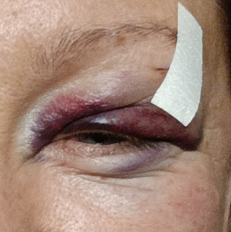 Лейкопластырем стянула края ранки