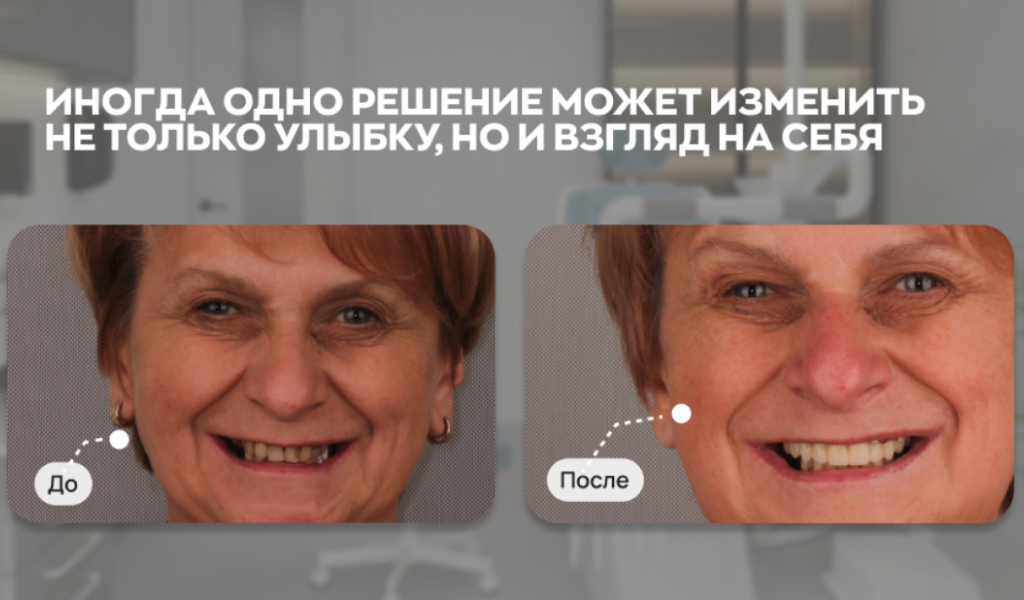 Фиксация полного несъемного протеза на 6 имплантах делается за 1 день. Елена Николаевна получила новые зубы, которые выглядят и ощущуются как свои. 