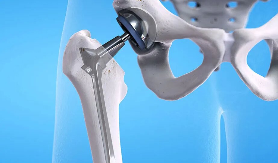 Когда суставы «ломаются»: всё, что нужно знать о протезировании — от страха до новой жизни