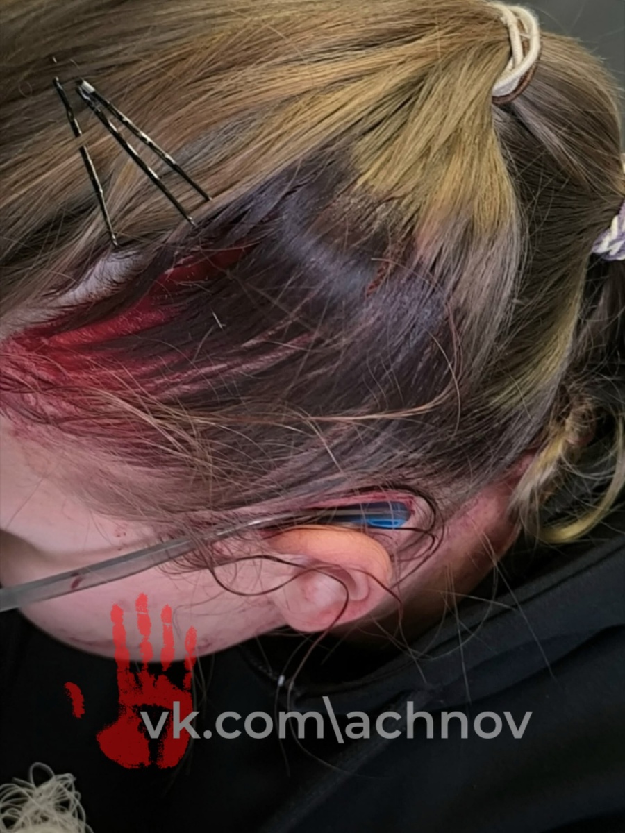 Последствия прилета кружки на голову