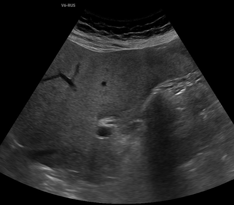 Рис. 1. Ультразвуковая картина сморщенного желчного пузыря, содержащего камень.