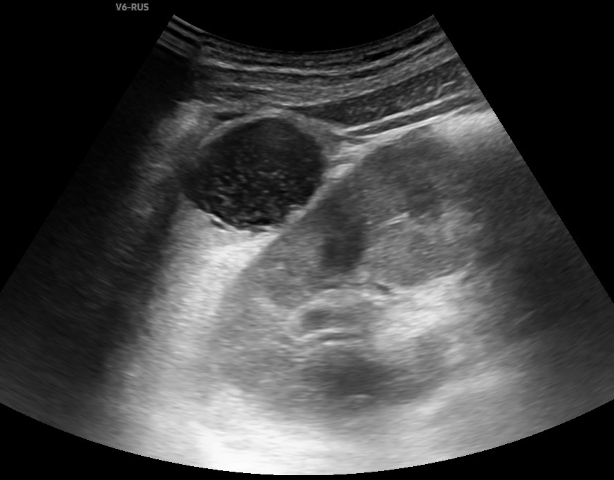 Рис. 1. Образование в селезенке.