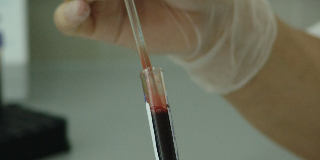 Ученые выяснили, как возраст донорской крови влияет на развитие Альцгеймера