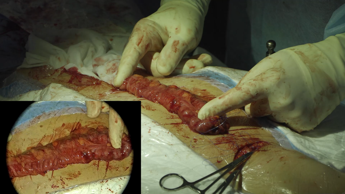 Выведенный наружу толстокишечный трансплантат в белом свете до наложения анастомоза