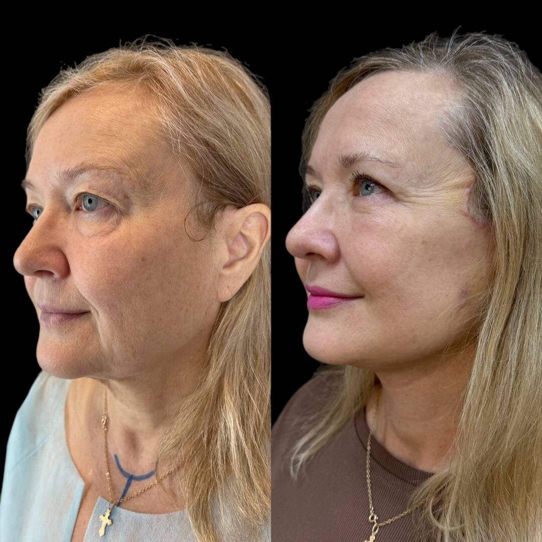 🔥 Потрясающий результат нашего врача-пластического хирурга Анны Викторовны Герасимовой! 4 недели после операции. Пациентке были выполнены: 
• Нижняя и верхняя блефаропластика. 
• Подтяжка лица и шеи в технике deep plane. 
• Липофилинг лица и шеи.

