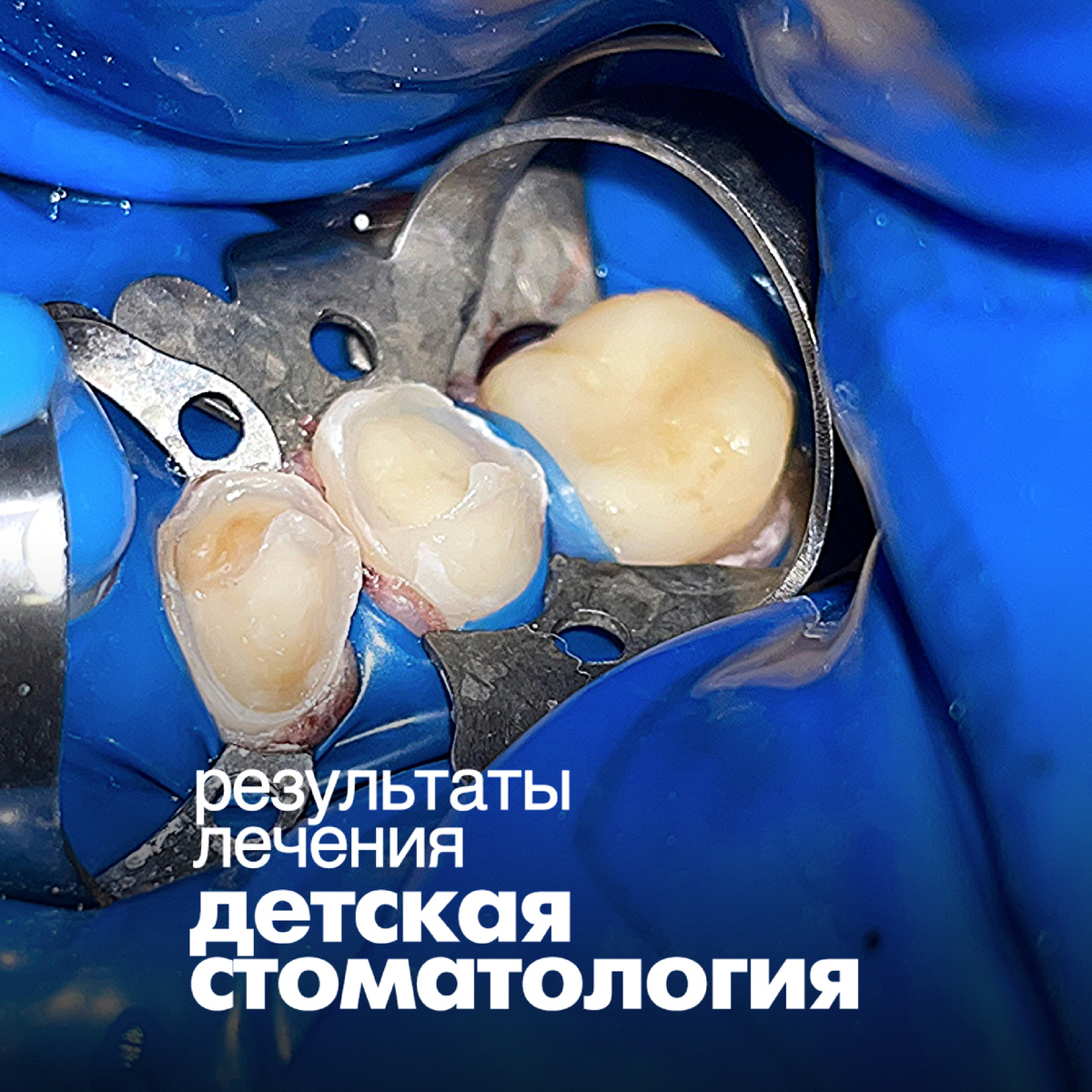 Стоматологическое лечение детей с особенностями развития (аутизм) в условиях общего наркоза