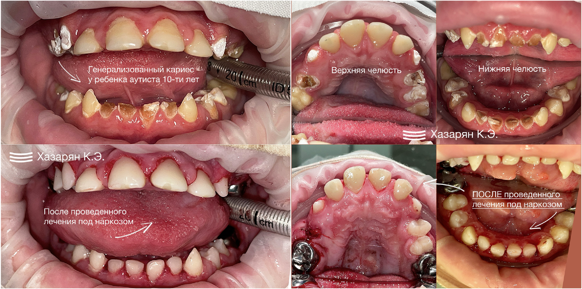 Проведена комплексная полная санация полости рта у ребенка (аутиста) 10-ти лет