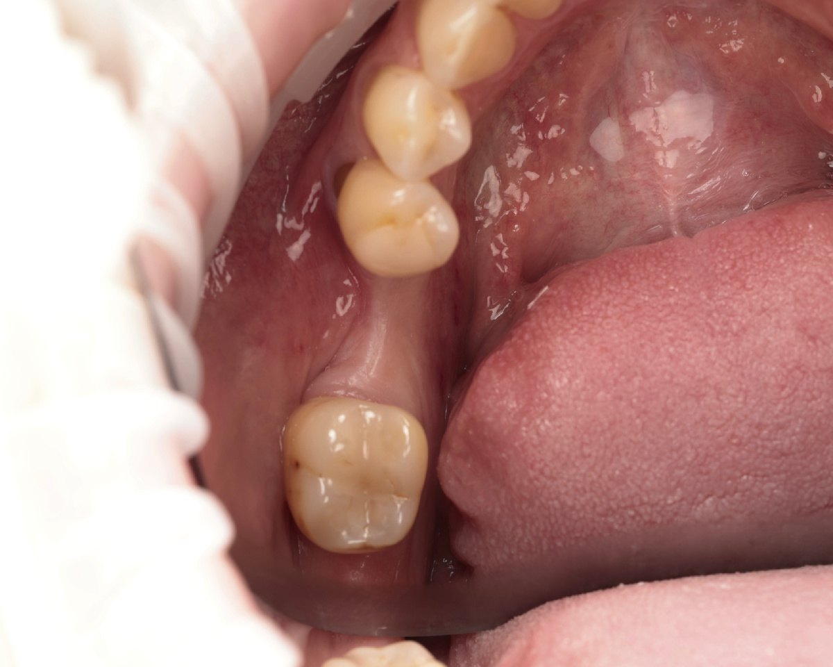 Проблемная зона перед имплантацией