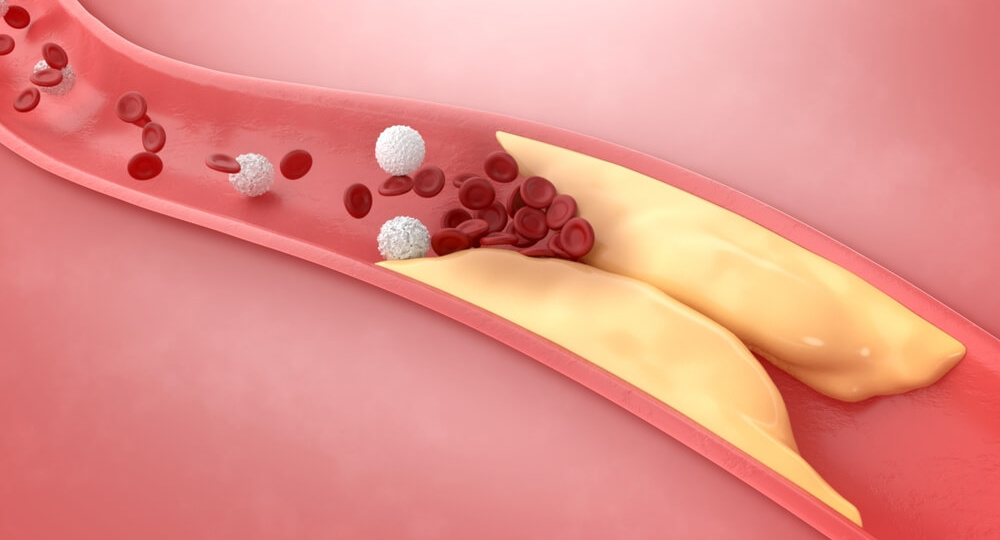 Вы сидите на диете, а холестерин растет? 4 неочевидные причины - и это не еда