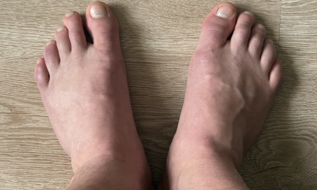 Отечность, чувство распирания или синюшный оттенок