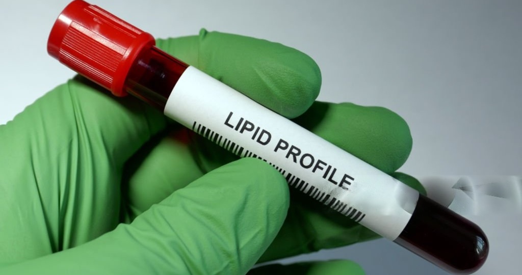 Липидный профиль: что скрывает этот анализ и как избежать инфаркта? Расшифровываем результаты вместе с врачом