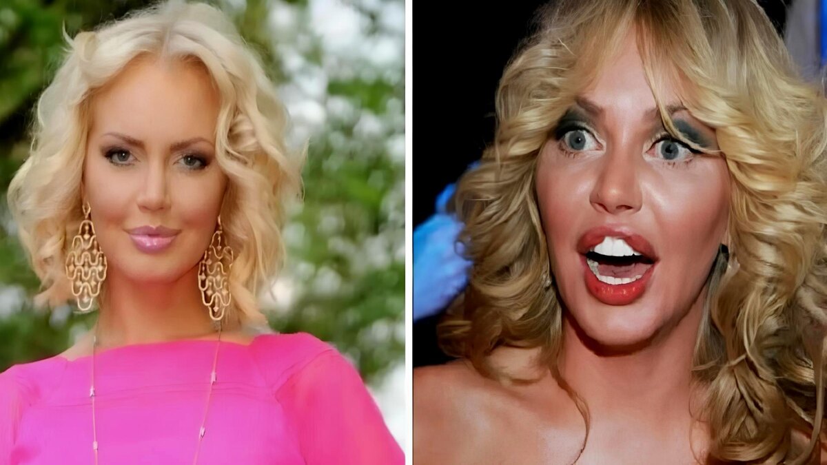 Минус индивидуальность? 15 фото российских звйзд До и После пластики, от которых бегут мурашки