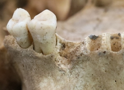 Примеры сточенных под углом зубов жителей Укека. Фото из личного архива Антона Кочнева.