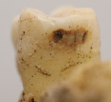 Примеры кариеса жителей Твери. Фото из личного архива Антона Кочнева.