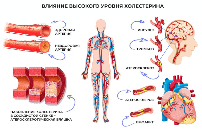 Холестерин под контролем: 8 простых упражнений, которые снижают «плохой» и повышают «хороший» — без таблеток и диет!