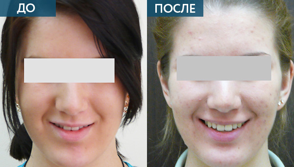 Диагностика и лечение дисфункции ВНЧС ДО и ПОСЛЕ 