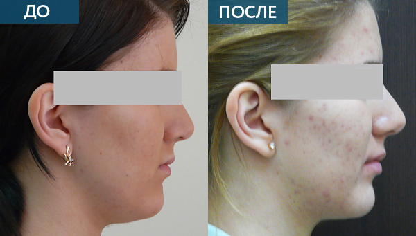 Ортодонтическое лечение дисфункции ВНЧС до и после