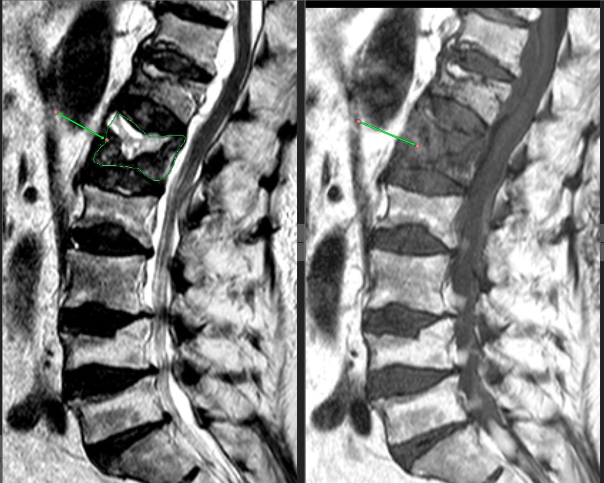 На видео - состояние позвоночника после металлофиксации при переломе на фоне метастазов.
