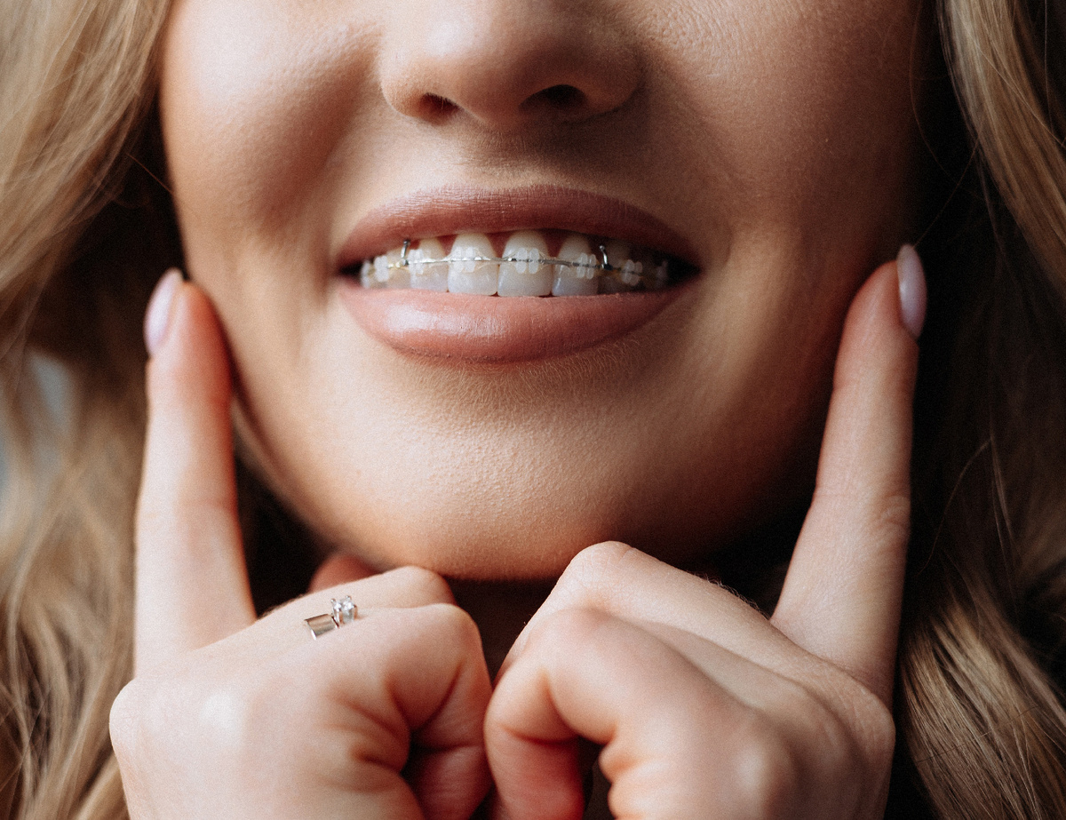 Так выглядят керамические брекеты. Фото пациентки Олеси Викторовны. 