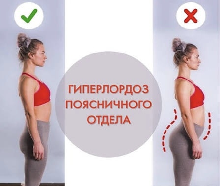 И также в большинстве случаев боль в спине сопровождается типо осанки «гиперлордоз», при котором у человека есть склонность к излишнему прогибу в пояснице (из-за напряжения ее мышц)