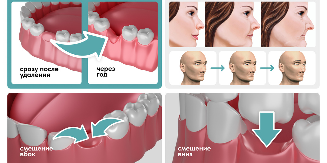 Нужно ли восстанавливать зубы срочно или можно подождать?