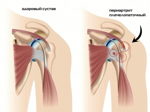 Почему болит плечо, если вы «ничего не делали»