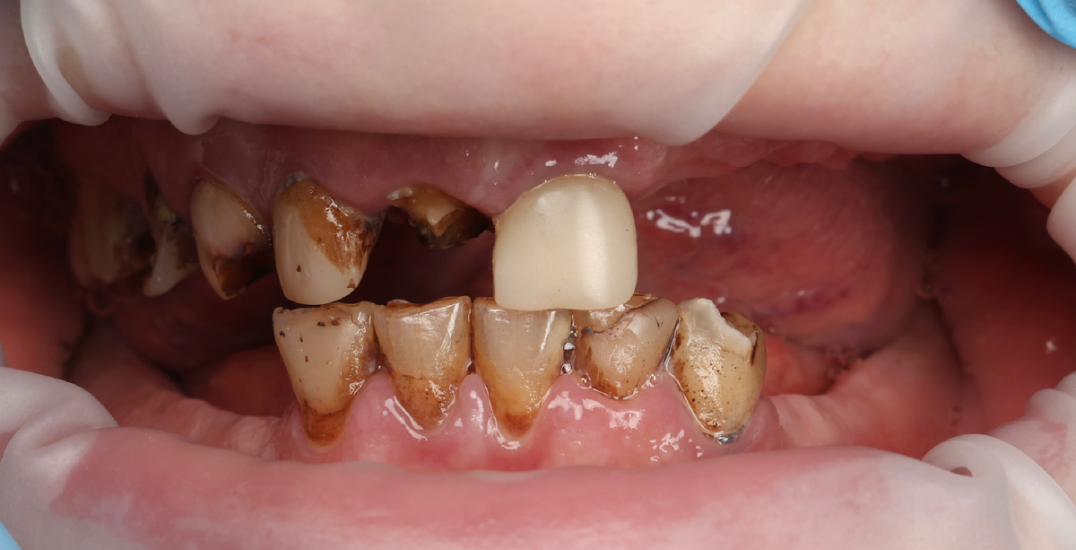 Состояние зубов "до"