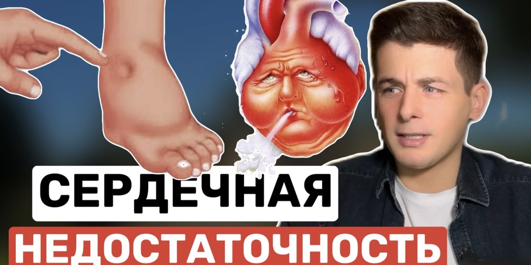 Хроническая сердечная недостаточность: Как понять, что она у вас есть, и что делать!