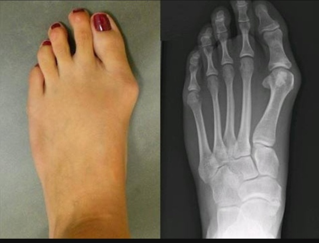 «Косточка» на ноге: почему с возрастом стопа «распластывается» и что с этим делать? Это не только эстетика