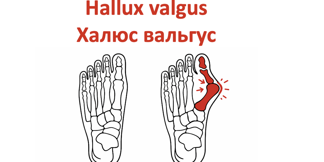 Hallux valgus / халюс вальгус